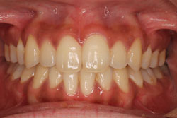 ホワイトニング